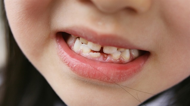Ağzında süt dişleri bulunan çocuklarda diş ayrıklığı normal bir durum iken 16 yaşından sonraki diş ayrıkları ise anormal bir durum olarak kabul ediliyor.