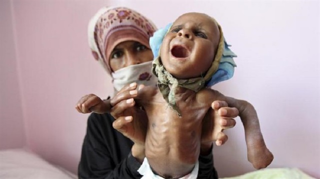 ​Birleşmiş Milletler (BM), Yemen'de 7 milyon kişinin açlık tehlikesiyle karşı karşıya olduğunu duyurdu.  