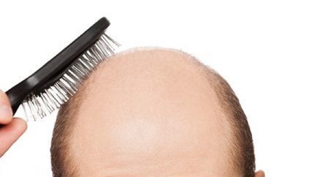اختصاصية تركية: معرفة سبب تساقط الشعر الطريق الوحيد لعلاجه