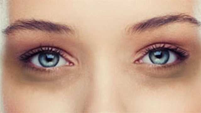 Göz ve göz çevresinde morluklar ya da diğer adıyla göz altı halkaları oluşabilir. Tedavi sistemik bozukluklara yarar sağlarken, kronik bozukluklarda sorun çözümlenmeyebiliyor. ​