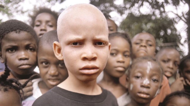Doğu Afrika’nın ilk genetik laboratuvarını Tanzanya’ya kuran Türkiye, sırf ‘albino’ doğdukları için kobay olma ya da tecavüz tehdidi altındaki insanlara umut oldu.