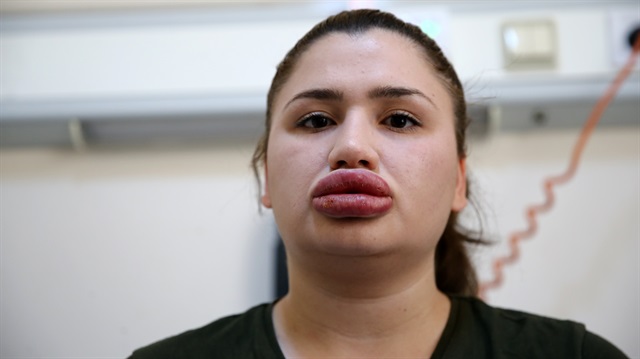 Adana'daki "estetik" mağduru hemşirenin hayatı boyunca dudak silikonuyla gezmesi gerekiyor.