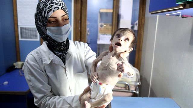 وفاة طفلين بسبب سوء التغذية في غوطة دمشق المحاصرة