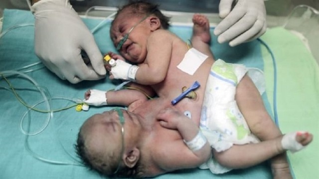 Gazze'de geçtiğimiz yıl dünyaya gelen yapışık ikizler hayatını kaybetmişti.