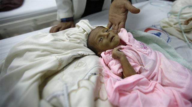 Doktor, iyi beslenemediği için sağlığı çok kötü olan bir çocuğu gösteriyor... Yemen, Sana.  Fotoğraf: AP