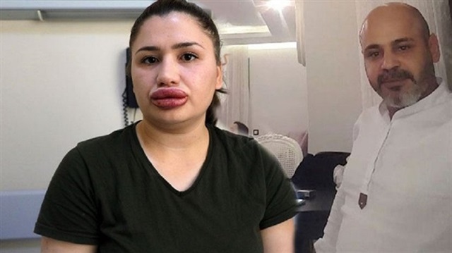 القضاء التركي يبتّ في قضية طبيب التجميل المحتال
