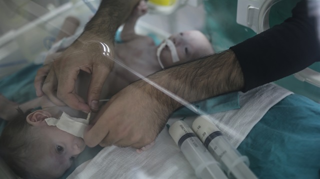 "فرح" و"حنين"..أول توأم سيامي من غزة يعيش لأكثر من شهر