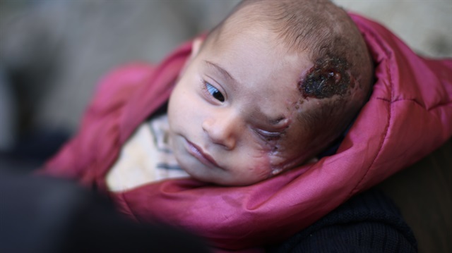 Kerim bebek, Doğu Guta'da uğradığı hava saldırısında annesini ve gözünü kaybetti. 