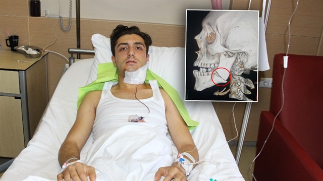 19 yaşındaki üniversite öğrencisi Hasan Bayraklı, 5 saat süren bir ameliyat geçirdi. 