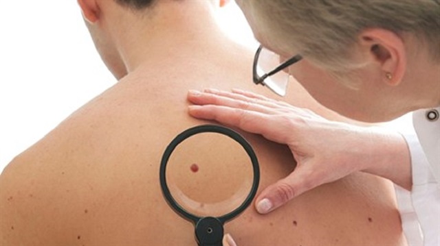 دراسة بريطانية: عقار لالتهاب المفاصل يكافح سرطان الجلد 