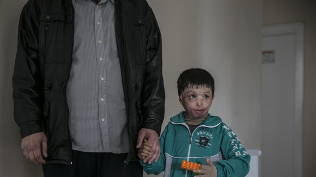 أحرقته براميل الأسد.. الطفل "حسن" يعاني الحروق في تركيا