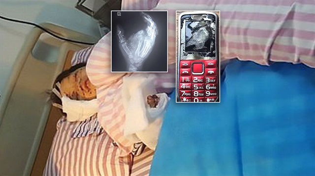 Patlayan telefonla yaralanan çocuk hastanede tedavi görüyor.