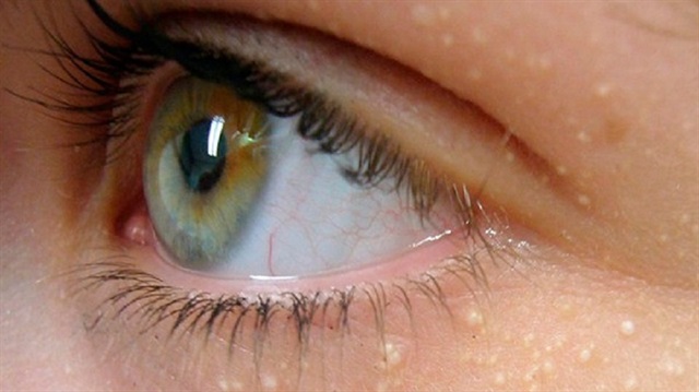 Uykusuzluk, yorgunluk, üzüntü, ağlamak gibi durumlar da göz altı yağlarının artmasına sebep olabiliyor.