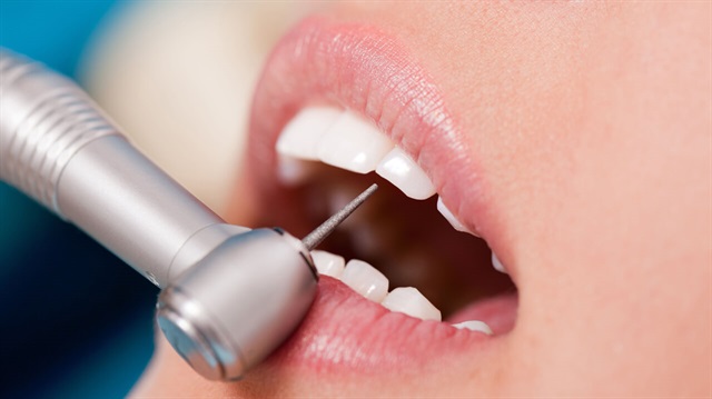 Kanal tedavisiyle ilgili doğru bilinen yanlışlar diş kaybına neden oluyor. 