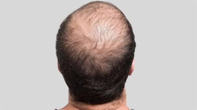 ​

اكتشاف علاج جديد يعزز نمو الشعر ويقضي على الصلع