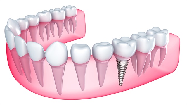 Tek diş eksikliğinde yandaki sağlam dişlere dokunulmak istenmediğinde tek implant uygulanır.