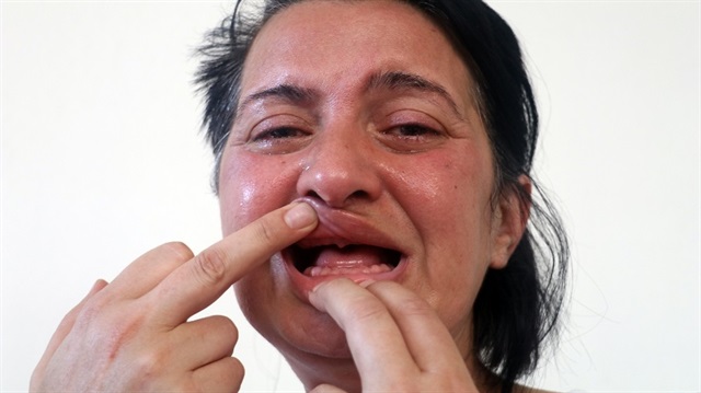 Diş sağlığını kaybeden genç kadın, yeniden dişlerine kavuşmak istiyor.
