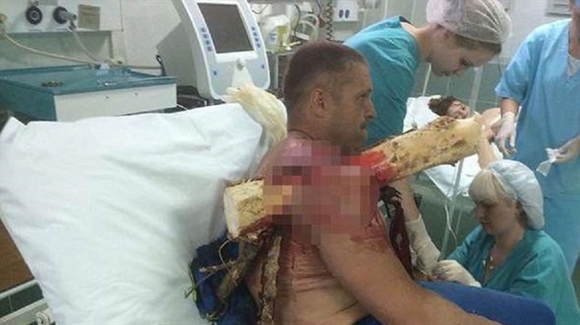 Kütük vücuduna saplanan adam arama kurtarma ekipleri tarafından hastaneye kaldırıldı.