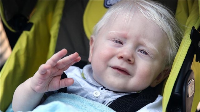 Albinizmin bir hastalık değil, genetik bir durum.