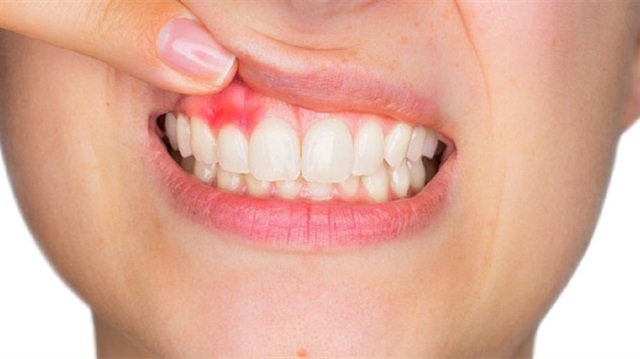 Ağızda oluşan enfeksiyonlar ve diş çürükleri başka hastalıkları tetikliyor.