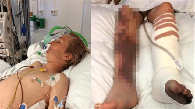 14 yaşındaki çocuk menenjit nedeniyle bacağını kaybetti.