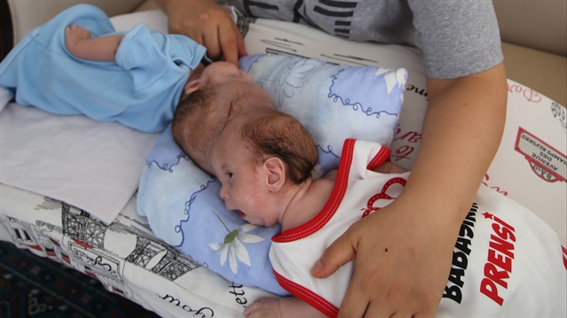 Antalya'da kafadan yapışık dünyaya gelen siyam ikizleri 6 aylıkken ameliyat olacak.