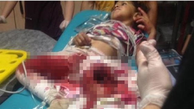 Elbisesi patos makinesine sıkışan minik kız ağır yaralandı