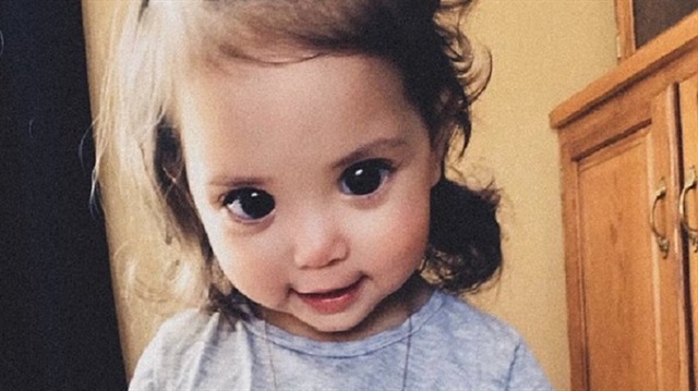 Mehlani Martinez'in göz bebekleri genetik bir bozukluk nedeniyle diğer insanlardan daha büyük.
