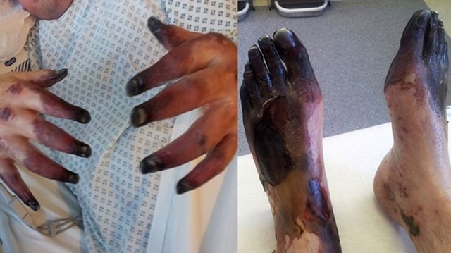 Sistemik skleroz hastası olan adamın el ve ayakları hastalık nedeniyle kangren oldu.