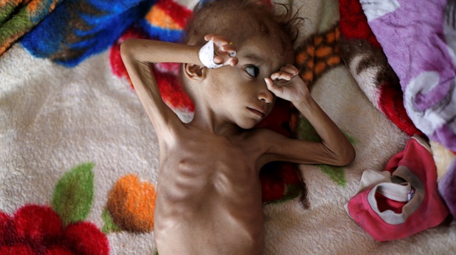 Yemen, dünyanın en büyük insani krizlerinden birini yaşıyor. (Fotoğraf: Reuters)