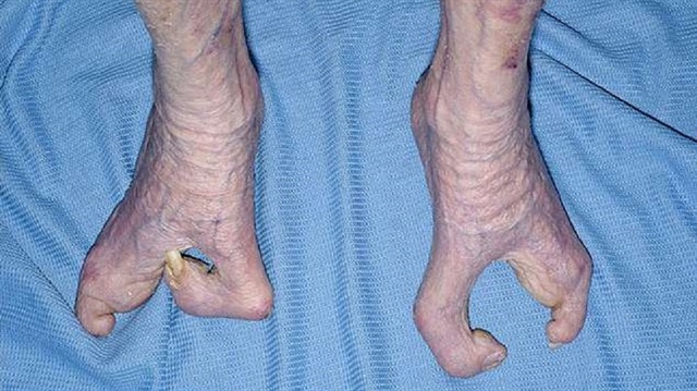 İngiltere’de 94 yaşındaki bir büyükanne, ‘ıstakoz kıskacı’ olarak da adlandırılan kemik hastalığıyla hayatı boyunca mücadele etti. 