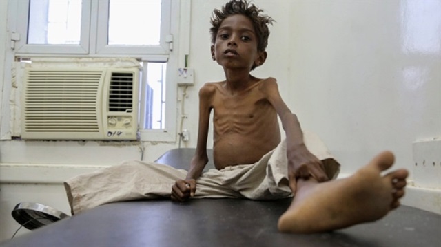 يونيسيف: 2.2 مليون طفل يمني يعانون من سوء التغذية الحاد