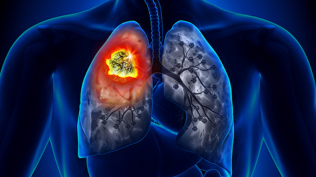 Akciğer kanserinden korunmanın 6 yolu