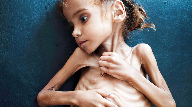 Yemen’de dünyanın en büyük açlık krizini çıkardı