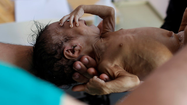 Yemen'de açlık sebebiyle her 10 dakikada 1 çocuk ölüyor. 