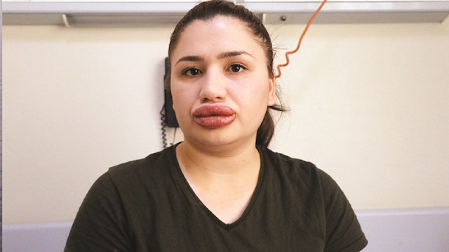 Merve Keleş, Adana’da internette kendisini estetik uzmanı olarak tanıtan kuaför S. G.’ye dudak silikonu yaptırmıştır