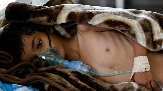 An eight-year-old malnourished boy lies on a bed in the emergency ward of a hospital 