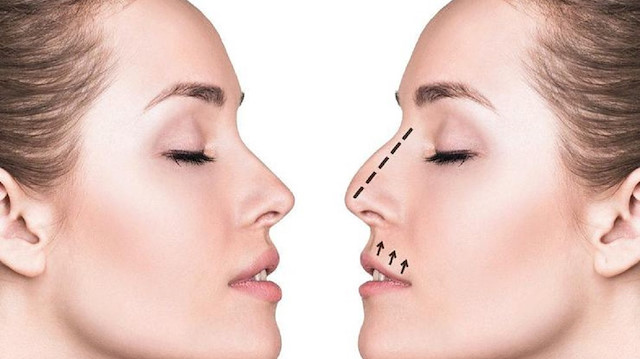 Burun ameliyatlarında kullanılan kıkırdaklar kendi burnunuzdan çıkıyor.