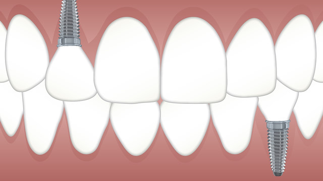 İmplant Diş Tedavisi Kampanyası