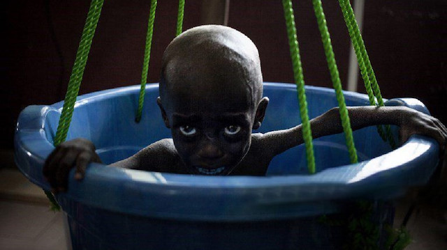 Somalili çocukların büyük çoğunluğu yetersiz beslenme nedeniyle ölümün eşiğinde. (Fotoğraf: AFP)