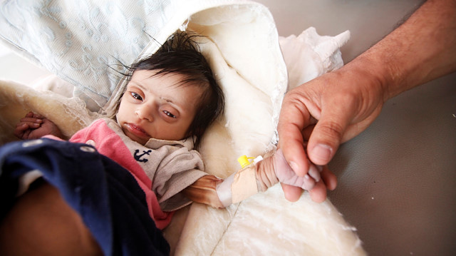Yemen'de görev yapan bir hemşire iki gün önce yetersiz beslenen iki aylık bebeğin fotoğrafını paylaştı.