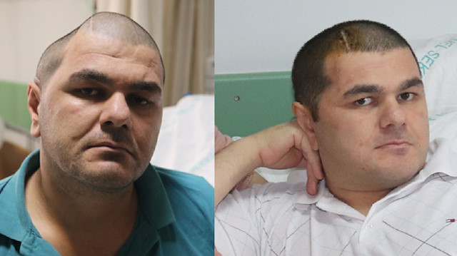 Kafatası eksik olan 34 yaşındaki Hasan Ayhan, 3D teknolojisi ile kafatasına kavuştu.