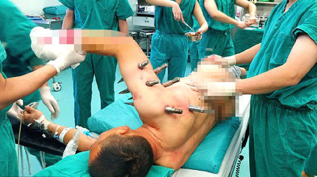 Hastaneye kaldırılan işçiye, 10 doktorun katıldığı bir operasyonla müdahale edildi. 