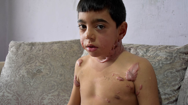 ​Vücudundaki yanıklardan utanan 6 yaşındaki Siraç, okula gitmek istemiyor.