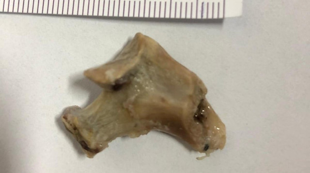 3 gün önce kemikli et yiyen 60 yaşındaki kadının boğazından 3 santimetrelik kemik çıkarıldı.