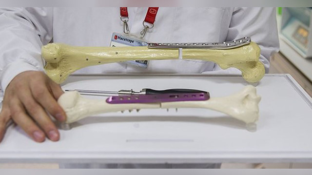 طبيب تركي يحصل على براءة اختراع عن آلية لتطويل العظام