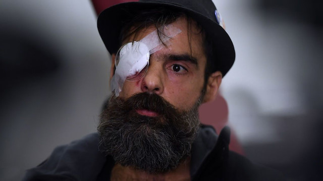 Sarı Yelekliler grubunun liderlerinden Jerome Rodrigues, gösterilerde gözünden plastik mermiyle vuruldu. (Fotoğraf: AFP)