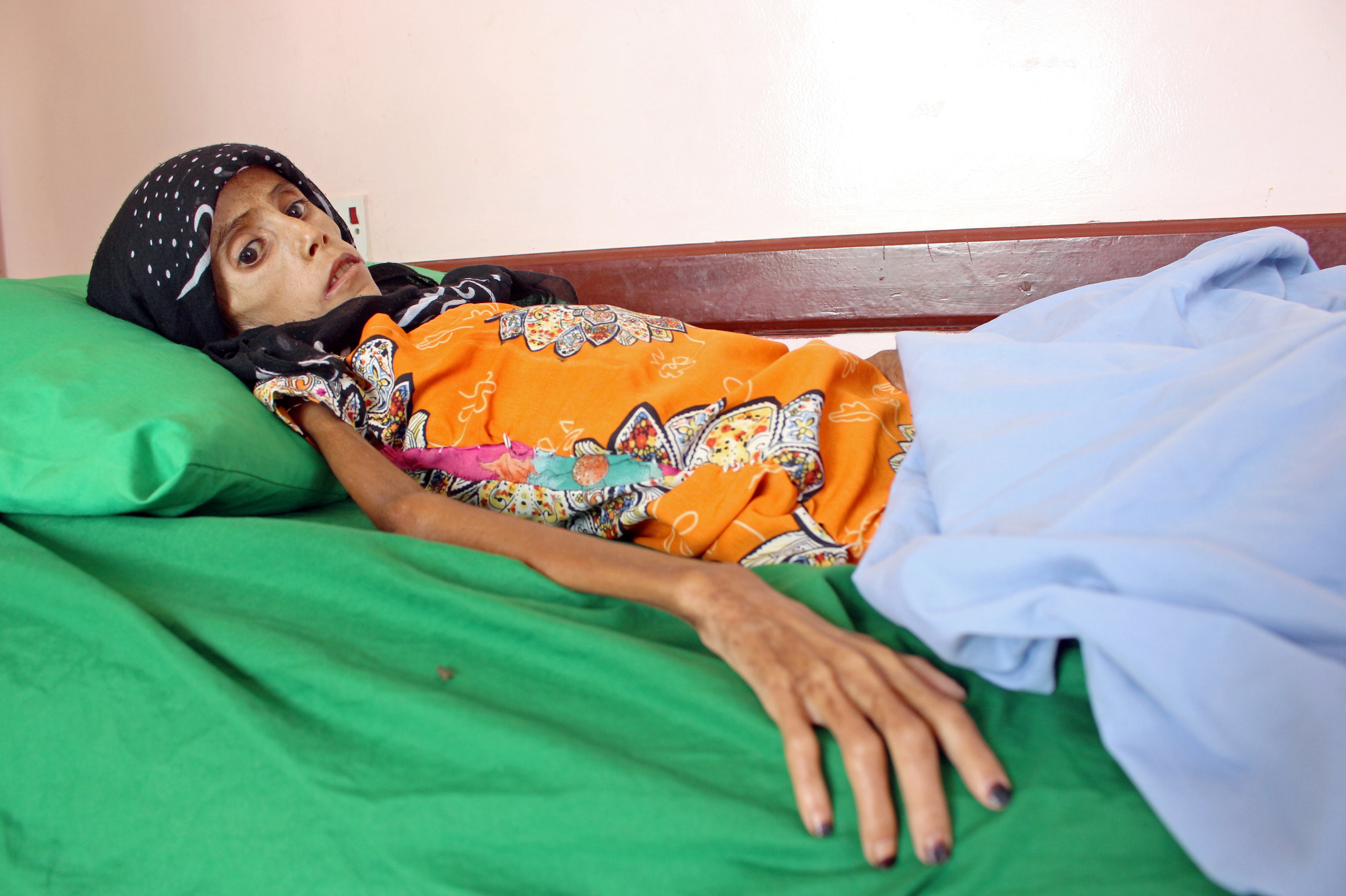 Yemenli Fatima, 12 yaşında ve sadece 10 kilo.