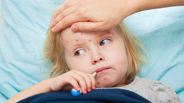 Kızamık, çocuklarda daha sık olmakla birlikte her yaşta görülebilen aşı ile önlenebilen bulaşıcı bir hastalıktır.