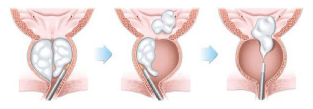 HoLEP nedir? HoLEP Prostat ameliyatı nasıl yapılır? Prof. Dr. Tibet Erdoğru  bilgilendiriyor - Yeni Şafak